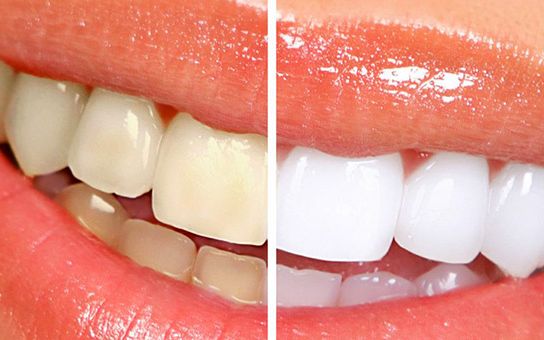 Zoom Whitening Before After